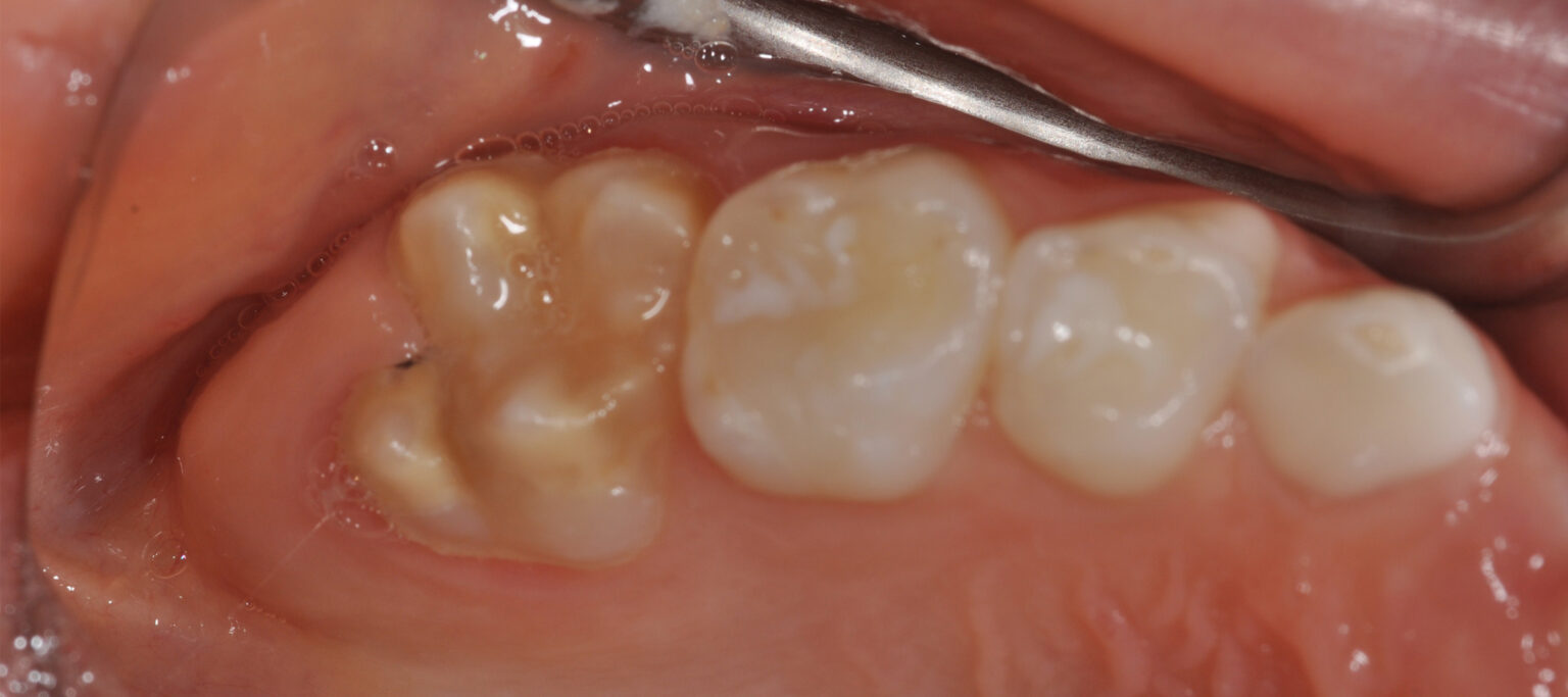 Ein Update zur Ätiologie undBehandlung der MolarenInzisivenHypomineralisation BZB online