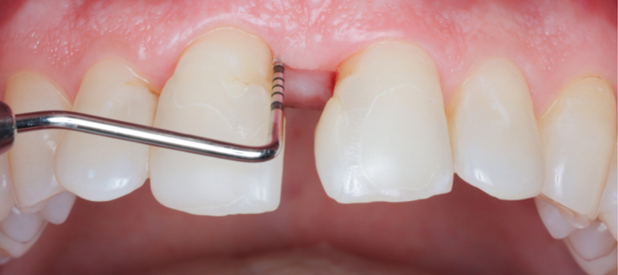 Minimalinvasive parodontale Regeneration