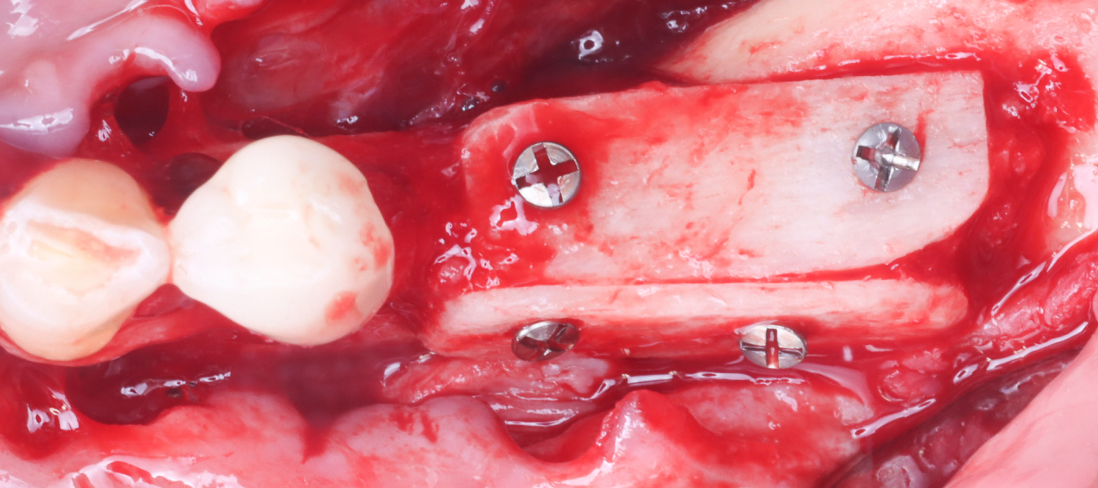 Vertikale Knochenaugmentation