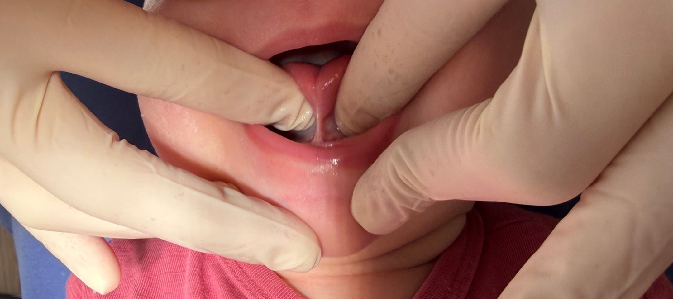 Ankyloglossie und Stillprobleme